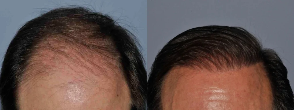 Before and after comparison of male hair restoration treatment.