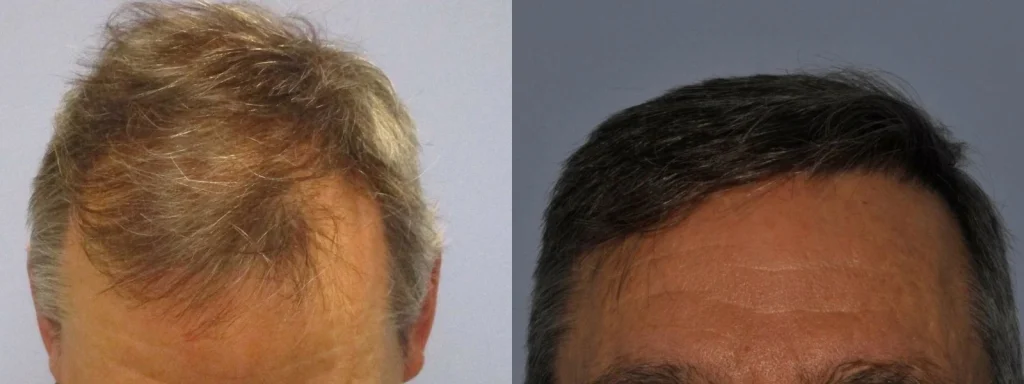 Before and after comparison of male hair restoration results.