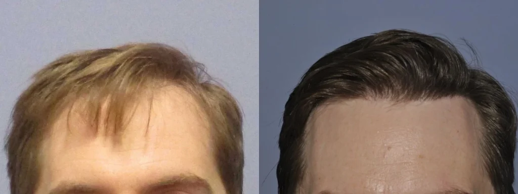 Before and after comparison of a male hair transplant result.