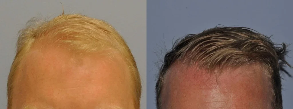Before and after comparison of male hair restoration treatment results.