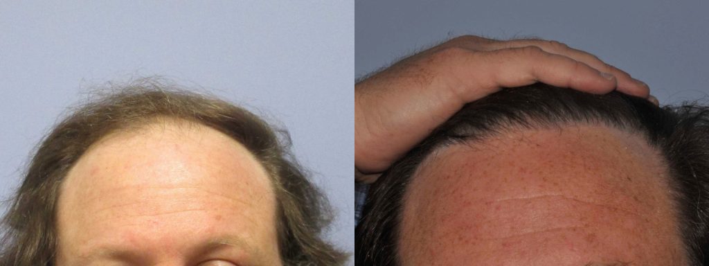 Before and after comparison of a hair transplant result.