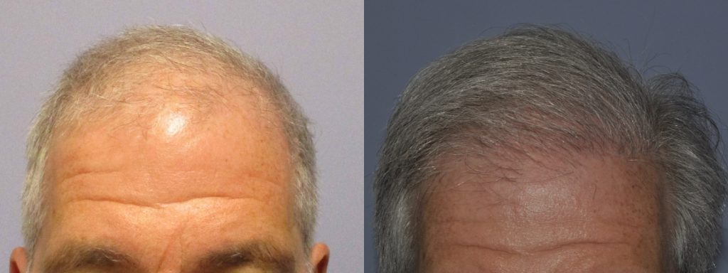 Before and after comparison of male hair restoration results.