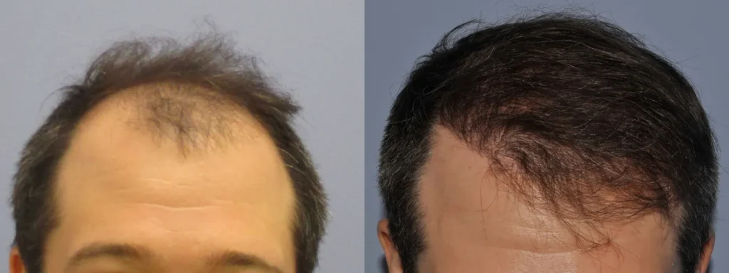 Before and after comparison of a man's hair restoration results.