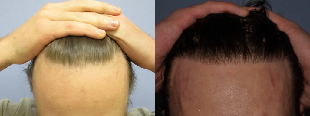 Before and after comparison of a man's hair transplant results.
