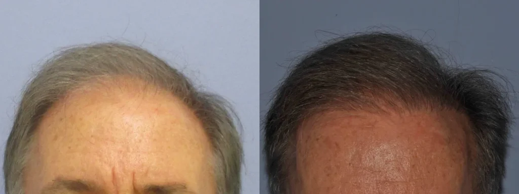Before and after comparison of a man's hair transplant results.